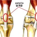 슬개골 탈구 - patella Luxation. 이미지