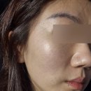 샤인 | 장산 피부과 리쥬란힐러 더마샤인 후기 효과