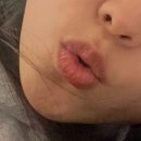 엘리스의원 | 부산 입술 점 빼기 “엘리스의원” | 아프지만 효과 확실했던 가성비 레이저 후기