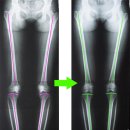 성누가재활의학과의원 | 무릎바깥쪽 뼈 튀어나옴 비골골두 돌출 타입의 오다리 하지부정렬 조기교정치료에 대해