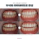 수성치과기공소 티스토리