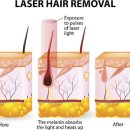 리마인드피부과의원 | 부천레이저제모, 에너지만 높이면 제모가 잘 될까?