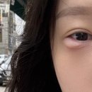 아산종합약국 | [진통제 약물 알레르기] 서울아산병원 진료+검사 후기🤧