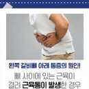 왼쪽 갈비뼈 통증 갈비뼈금통증 갈비뼈 골절 이미지