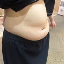 뽑고뽑고 | 여의도 람스후기 뱃살 지방 뽑고 일주일 후기! feat.고압산소치료