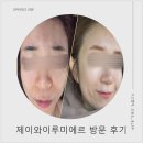 수원 피부관리 리뷰, 광교 에스테틱 제이와이루미에르 다녀 온 후기(비포&애프터 사진 있음)