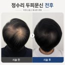 선레인아카데미신촌 | 신촌 두피문신 내돈내산 '선레인아카데미 홍대신촌' 만족한 솔직후기