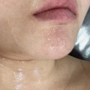 [대전 지족동 에스테틱 프린세스] 아토피 +극건성 피부 관리 후기