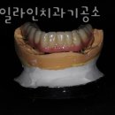 스마일라인치과기공소 네이버블로그