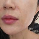 11545-03-25-42 | 쥬브젠&amp;덴서티 -실제부작용/불만족-팔자주름(자가진피재생술)시술 83일차