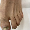단 한 번의 용기, 그리고 눈부신 변화 – 무좀 발톱 회복 이야기