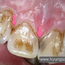 앞니 치아사이 충치 치과 레진 치료 이미지