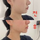 콰트로 | [부산 서면 피부과 추천] 이중턱 리프팅 추천 신형 티타늄 포트라콰트로 20KJ 솔직 후기!