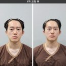 부산안면비대칭 한의원 얼굴 라인 교정 후기