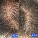 트리플에스 탈모샴푸 사용후기｜지루성두피·얇은모발 직접 써본 리얼 후기