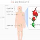 기쿠치씨 병 원인 증상 림프절 종대 림프절 특징 이미지