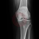 중앙보조기 | 무릎 관절염 보조기 — 언로더원 X(Unloader One X) 완벽 정리