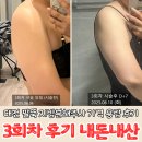 대전 팔뚝 지방분해주사 가격 용량 후기