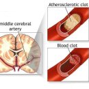 ※ 뇌졸중 전조증상 과 예방법※ 이미지