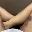 2차는 | 풀페이스 지방이식 2차 한달차 후기