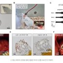 사람의 이마에 전극 삽입 이미지