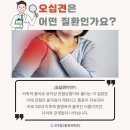 오십견의 원인과 비수술적 치료 네이버블로그