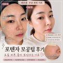 전이 좋아 | 용산피부과 포텐자 모공팁 후기｜요즘 피부 좋아 보인다는 이유