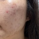천연소재로 만든 피지 조절제 피지웰 리포좀 다이렉트 추천후기