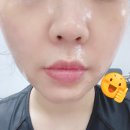 해피범박힐링대리점 | [공지] [내돈내산 인셀덤] 전주, 직접 사본 인셀덤, 13일차 후기-건조함 개선 중