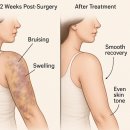 통일로 760 | 강남 청담동 팔 옆구리 등 지방흡입 후기 관리 및 통증 부작용