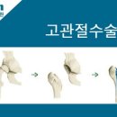 [고관절 인공관절] 노인성 고관절 골절시 인공관절로 치료하세요 이미지