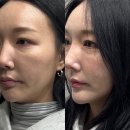 리움한의원 | 둔촌동한의원 리움한의원 40대 스킨부스터 솔직후기 스키장가서 죽은 피부 소생했어요