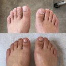 푸스케어 상인역점&더네일 | 포항 무좀발톱 검색하셨다면? 비올라 푸스케어에서 관리 받으세요 + 일주일 뒤 후기 발사진