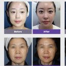 바이오미의원 네이버블로그
