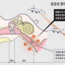 비행기 탄 뒤 먹먹해진 귀, 방치하면 만성 중이염으로 이어져... 이미지