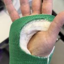 MS재건병원 | 척골 충돌 증후군 수술 한 달 후기