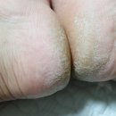 (주)닥터보청기 | 발각질제거기 닥터씨 풋케어 발뒤꿈치각질제거 효과 대박!!