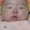 리숨 | 침독으로 뒤집어진 아기 피부, 리숨으로 케어한 후기