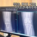 서울점프정형외과의원 | 십자인대 절골술 휜 다리 교정술 미세천공술 1년 후 핀 제거 수술 비용 회복 후기 ㅣ점프 정형외과
