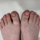 네일;그대와닥터아이티엔 | 대구 경산 내성발톱케어 경산무좀발톱케어 치유네일 닥터아이티엔