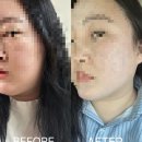 연세의원 | 당진 리프팅 추천｜연세강남의원 올라웨이브 솔직 후기 (내돈내산)
