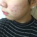 차오름한의원 | 여드름흉터한의원 효과 많이 본 차오름침 후기!!!