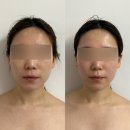 뷰티플렉스 미인만들기 | 천안 피부관리 뷰티투유 에스테틱 • 제로온다리프팅 받고 온 후기 (티리온-X 효과 찐 만족👍✨)