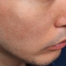 Begin English | 마포구피부과 스킨부스터 리투오 후기｜모공·흉터 관리 전후 변화