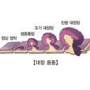 대장의 양성종양 (출처: 서울아산병원) 이미지