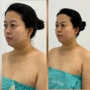 화합로 | 울산 남구 피부관리 고운빛깔 온. 다 무제한 샷 리프팅 후기