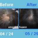 두피 탈모 아미치 0.3 수원점 이미지