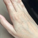 손등 검버섯 어떻게 없애나요ㅜㅜ (손등검버섯 없애는법, 검버섯 제거 연고 후기 궁금해요..) 이미지