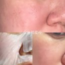 (주)메디바이오템 | 피부 응급처치템! 바이오셀룰로오스 72샷 메디팩 리얼 후기