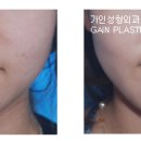 보조개1 이미지